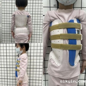 一例婴幼儿特发性脊柱侧凸保守治疗效果观察的病案分享